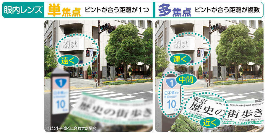 多焦点眼内レンズを用いた水晶体再建術