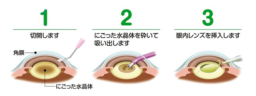 白内障治療について